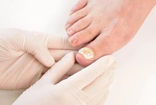 Doctors recommend female Broad Band for the treatment of mycosis