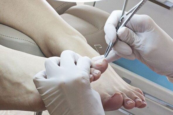 Mechanical removal of fungal -affected nails