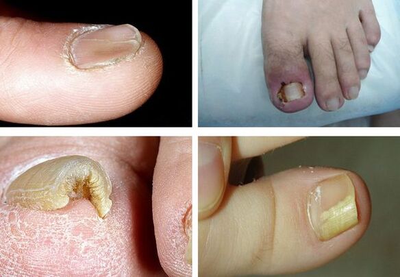 Symptoms of onycomycosis in the legs