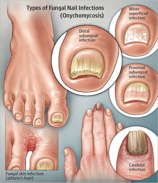 Types of onycomycosis