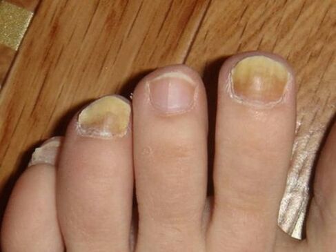 Fungus on the feet with damage to the nails