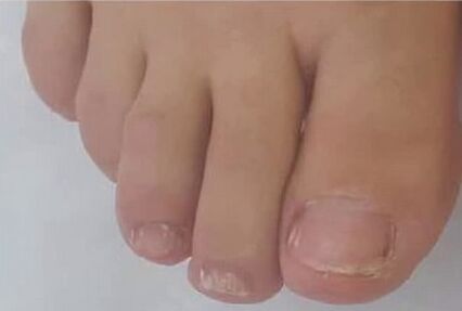 fungent band quickly rescued from mycosis
